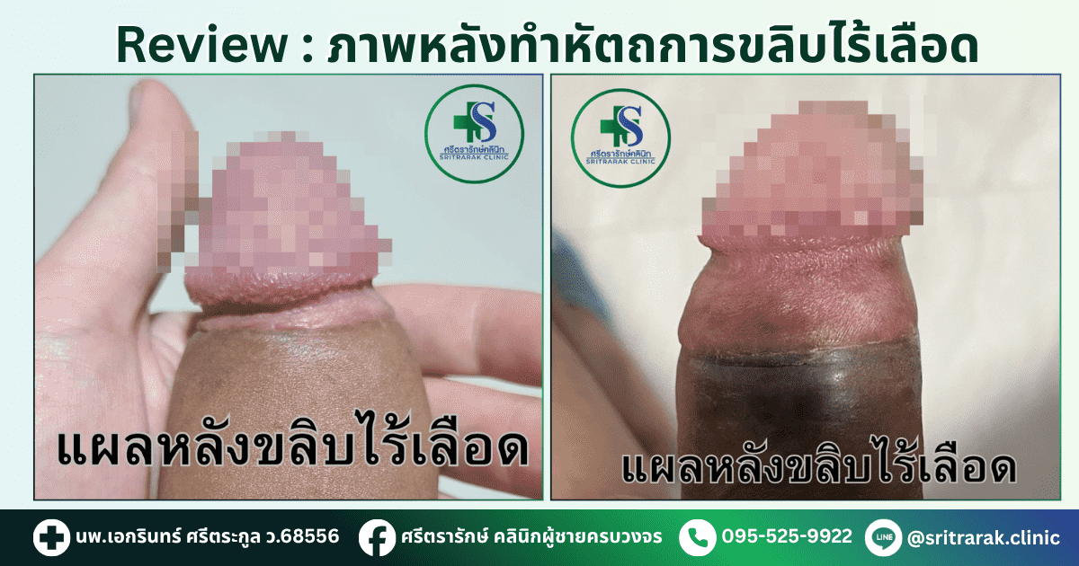 รีวิวขลิบไร้เลือด-ศรีตรารักษ์คลินิก