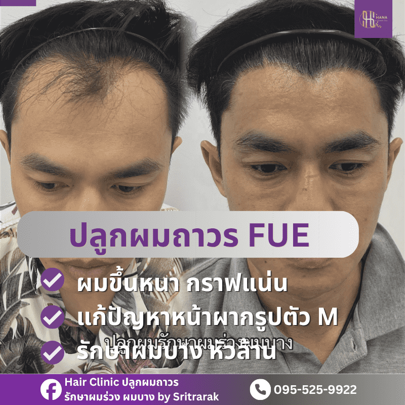 ปลูกผมถาวร FUE-ฮานาคลินิก โดยศรีตรารักษ์คลินิก-บ้านไผ่ขอนแก่น