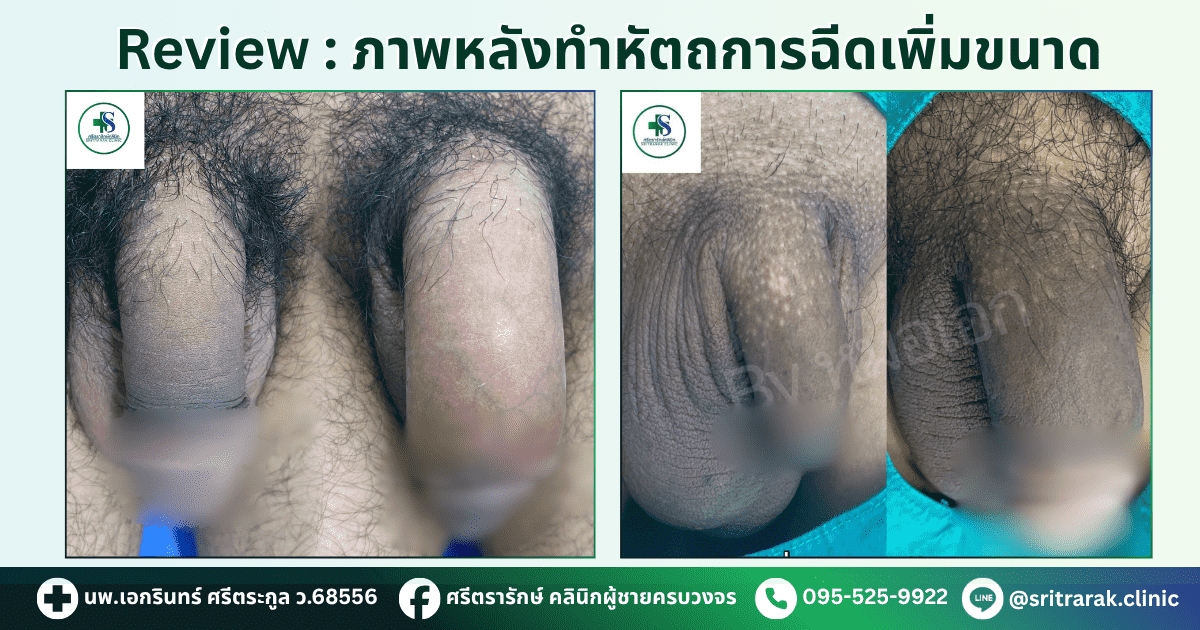รีวิวฉีดเพิ่มขนาดอวัยวะเพศ-ศรีตรารักษ์คลินิก-คลินิกผู้ชายครบวงจร-บ้านไผ่ ขอนแก่น
