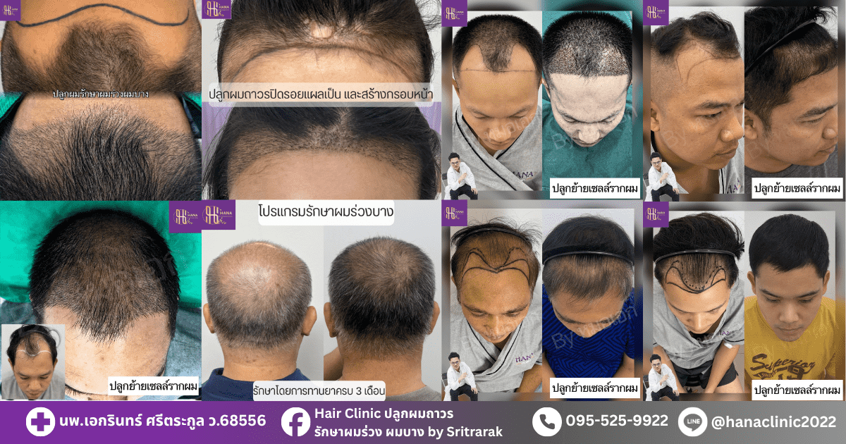 รีวิวปลูกผมถาวร FUE-ฮานาคลินิก โดยศรีตรารักษ์คลินิก-บ้านไผ่ขอนแก่น