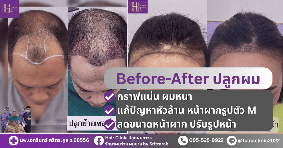 รีวิวปลูกผมถาวร-ฮานาคลินิก-โดยศรีตรารักษ์