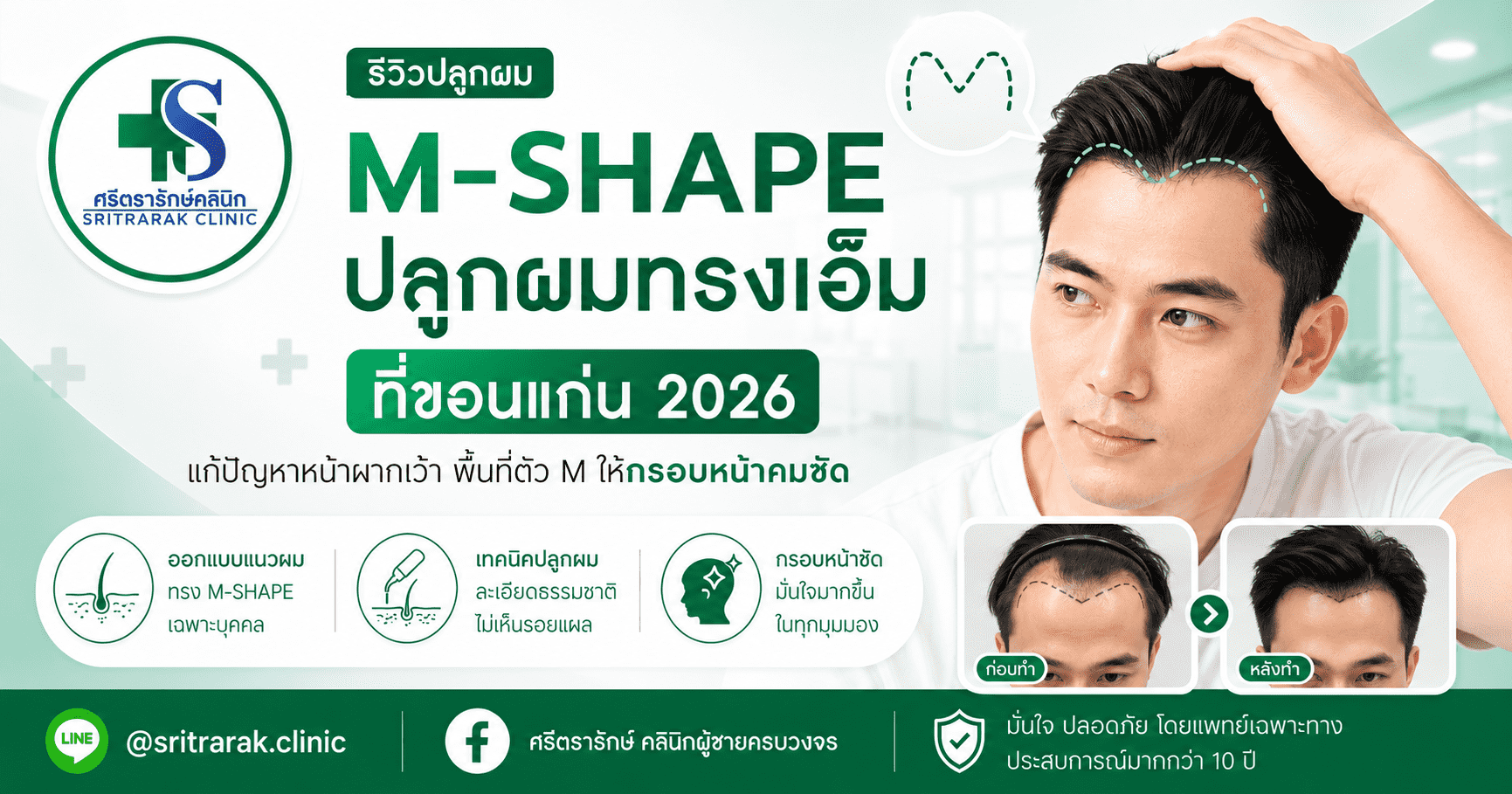 รีวิวปลูกผม-ขอนแก่น-มหาสารคาม-โดย-หมอเอก-ศรีตรารักษ์